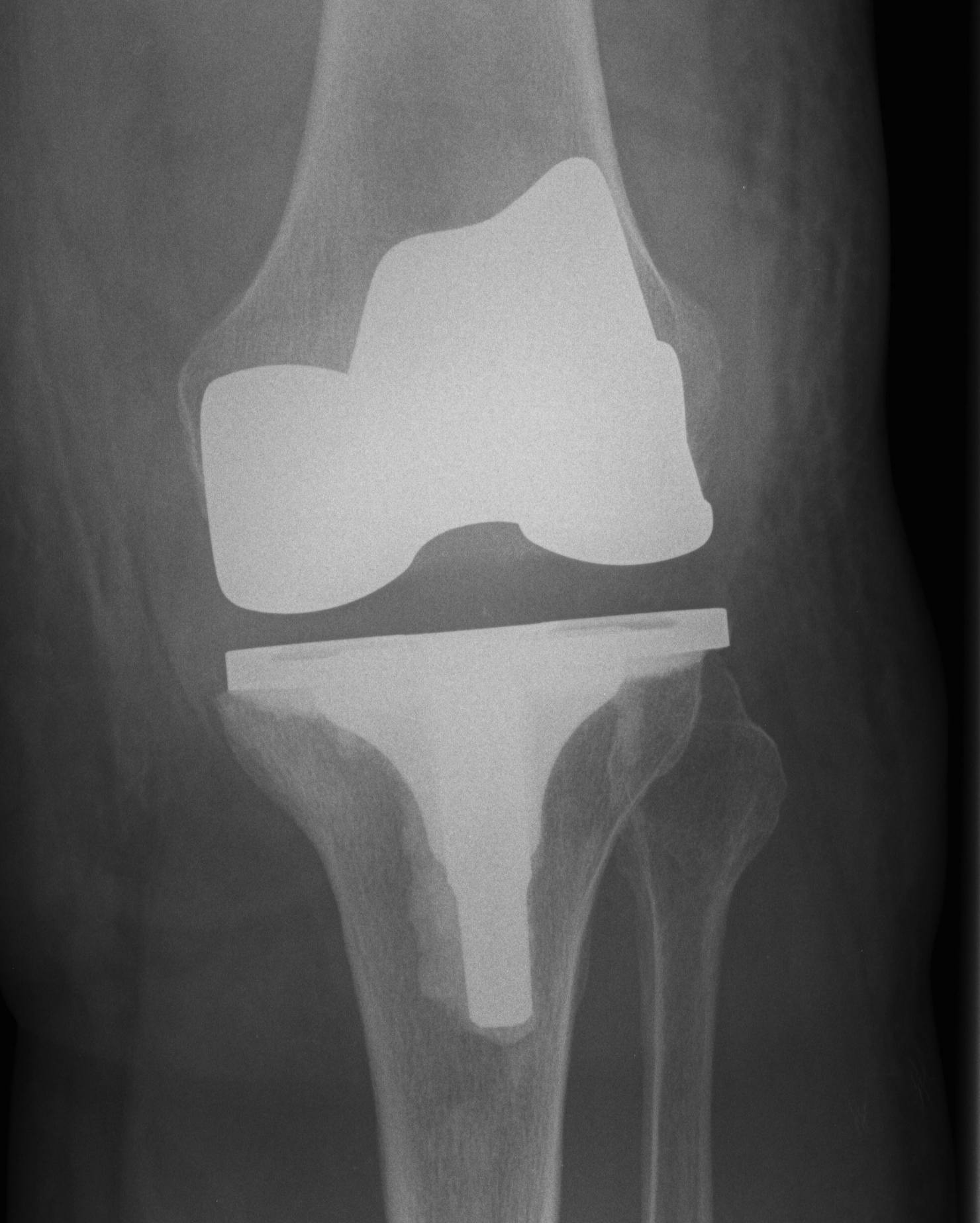 TKR Varus Tibial Implant